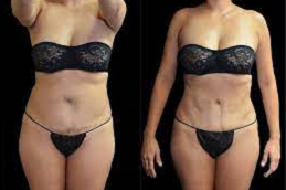 Liposuction Surgery Clinic
