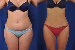 Liposuction Surgery