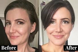 Liquid Facelift Clinic