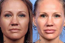 Liquid Facelift in Abu Dhabi & Al Ain