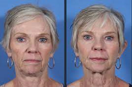 Liquid Facelift 5 Liquid Facelift in Abu Dhabi