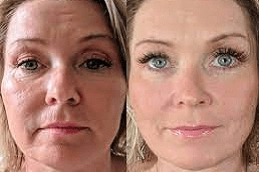 MESOGOLD Stamp Therapy Clinic in Abu Dhabi