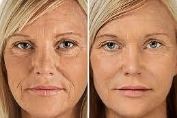 MESOGOLD-Stamp-Therapy-in-Abu-Dhabi