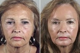 Mandelic-Peel-in-Abu-Dhabi-Al-Ain