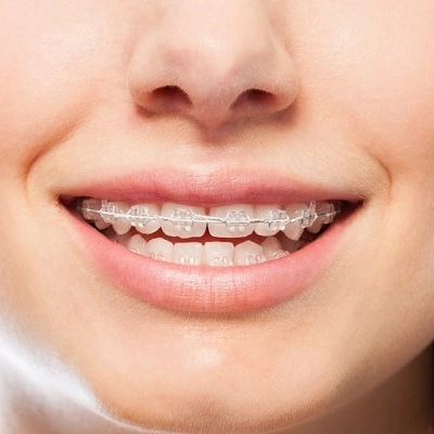 Metal Braces 2 Metal Braces in Abu Dhabi & Al Ain Cheap Dental Braces Cost