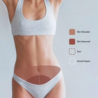 Mini-Abdominoplasty-Cost-in-Abu-Dhabi