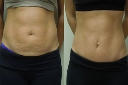 Mini-Abdominoplasty-in-Abu-Dhabi-Before-Al-Ain