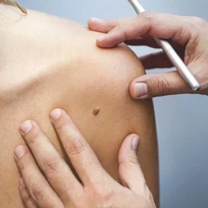 Blog 1 Mole-Removal-How-Does-it-Works-Laser-Mole-Removal-Abu-Dhabi