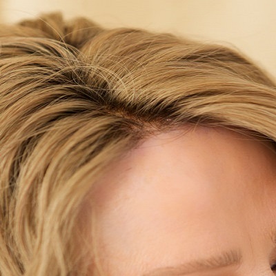Natural Hairline Treatment 2 Natural Hairline Treatment in Abu Dhabi Al Ain Natural Hairline Cost