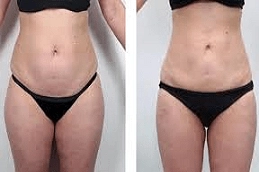 Non Invasive Fat Removal Clinic in Abu Dhabi