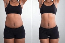 Non Invasive Fat Removal Clinic in UAE