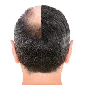 Blog 1 Non-Surgical-Hair-Replacement-Cost-in-Abu-Dhabi-Al-Ain