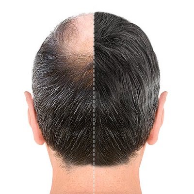 Non-Surgical Hair Replacement Cost in Abu Dhabi 4 Non-Surgical-Hair-Replacement-Cost-in-Abu-Dhabi-Al-Ain
