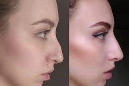 Non-Surgical-Nose-Job-Clinic-in-Abu-Dhabi