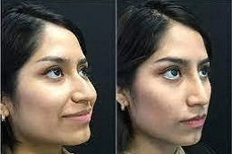 Non-Surgical-Nose-Job-in-Abu-Dhabi-Al-Ain.