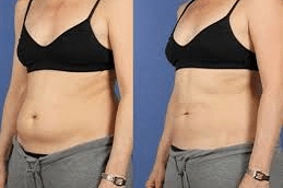 Non invasive Fat Removal