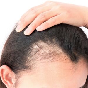 Blog 3 PRP for Hair Loss in Abu Dhabi Al Ain PRP for Hair
