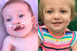 Palate Repair Surgery in Abu Dhabi & Al Ain