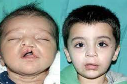 Palate Repair Surgery in Abu Dhabi