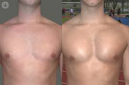 Pectoeral Inmplants in Abu Dhabi