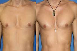 Pectoral Implants Clinic in Abu Dhabi