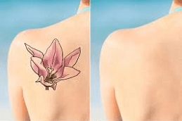 Picosure Tattoo Removal Clinic in Abu Dhabi UAE