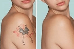 Picosure Tattoo Removal 5 Picosure Tattoo removal