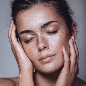 Pigmentation-Treatment in Abu Dhabi Al Ain Melasma Treatment