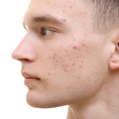 Pimples Treatment 2 Pimples Treatment in Abu Dhabi & Al Ain