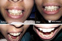 Polishing-Scaling-Treatment-in-Abu-Dhabi