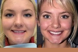 Porcelain Dental Veneers 5 Porcelain-Dental-Veneer