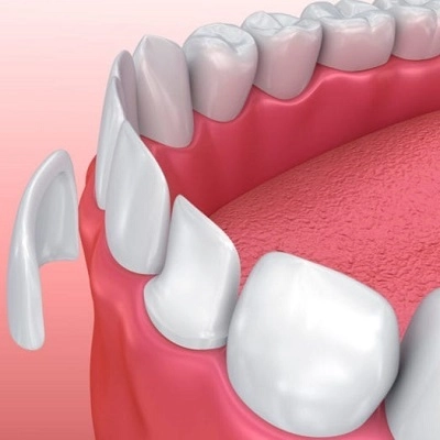 Porcelain Dental Veneers 2 Porcelain Dental Veneers in Abu Dhabi & Al Ain Cost & Price