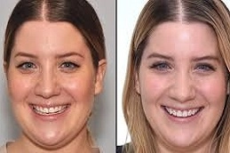 Porcelain-Dental-Veneers-in-Abu-Dhabi-Al-Ain