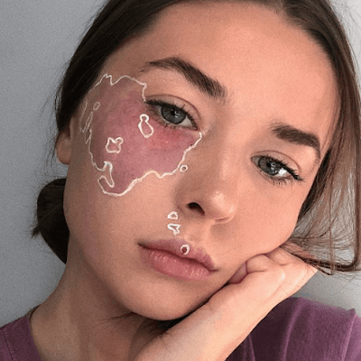 Port Wine Stains Removal Treatment in Abu Dhabi & Al Ain