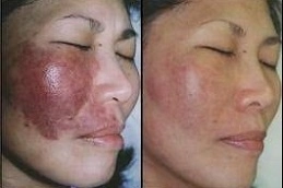 Port-Wine-Stains-Removal-in-Abu-Dhabi-Al-Ain