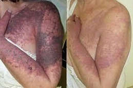 Port-Wine-Stains-Removal-in-Abu-Dhabi