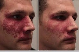 Port-Wine-Stains-Removal