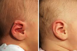 Preauricular Tag Removal in Abu Dhabi & Al Ain