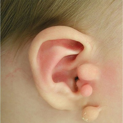 Preauricular Tag Removal in Abu Dhabi