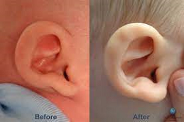 Preauricular Tag Removal in Abu Dhabi