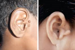 Preauricular Tag Removal