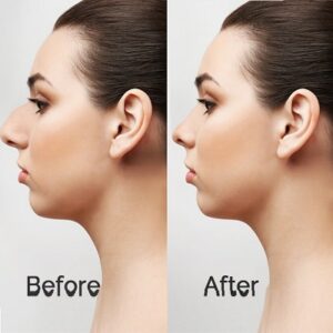 Blog 1 Rhinoplasty in Abu Dhabi Before After Nose Job