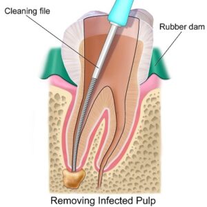 Root Canal Treatment Cost in Abu Dhabi Al Ain Enfield Royal
