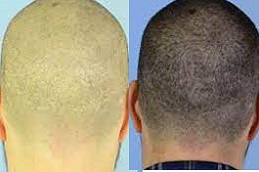 Scarless Hair Transplant in Dubai & Al Ain