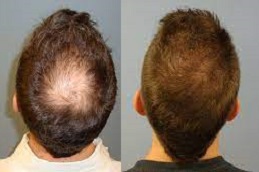 Scarless Hair Transplant in UAE