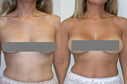Short Scar Breast Augmentation n Abu Dhabi