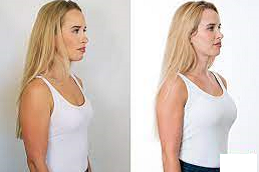 Short Scar Breast Aumnentation Clinic in Abu Dhabi UAE
