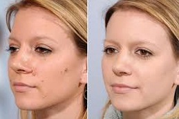 Skin Lesion Removal 5 Skin Lesion Removal Clinic in Abu Dhabi & aL aIN