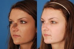 Skin Lesion Removal Clinic in UAE