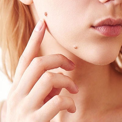 Skin Lesion Removal 2 Skin Lesion Removal in Abu Dhabi Al Ain Clinic